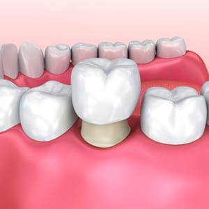 Animated dental crown placement