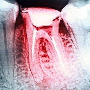 X ray of damaged tooth before extraction