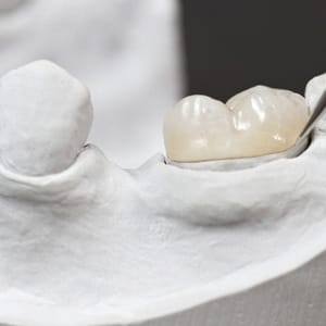 A metal free dental crown on smile model