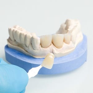 Veneers being placed over the model of a tooth