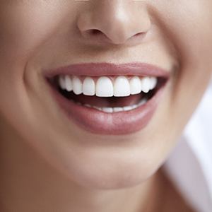 Closeup of smiling patient with veneers in Lincoln