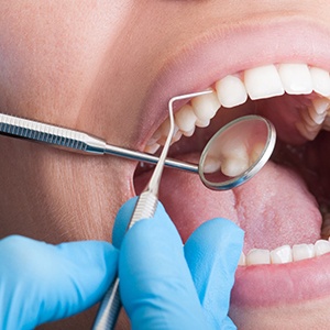 Closeup of patient’s mouth during oral examination