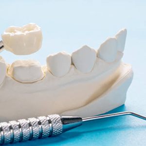 Dental crown on mold of mouth