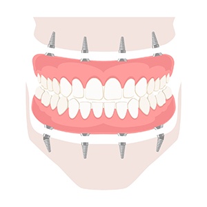 Full set of implant dentures for upper and lower arch