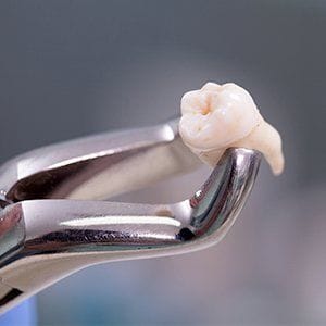 Clasp holding extracted tooth