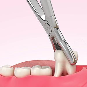 Animated tooth extraction process