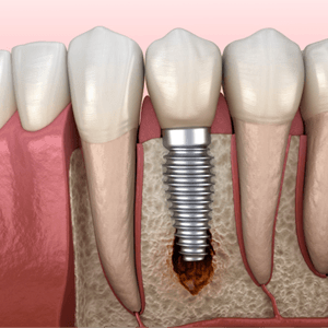 Illustration of peri-implantitis infection