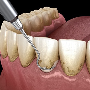Scaling and root planing removes dangerous bacteria from the teeth 