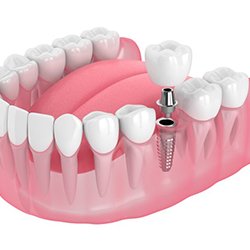 Animated smile during dental implant supported dental crown placement