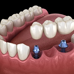 dental bridge being placed onto two dental implants 