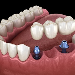 Animated smile during dental implant supported dental bridge placement