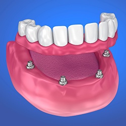 Animated smile during dental implant supported denture placement