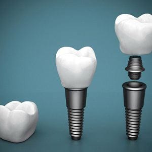 Diagram showing different parts of dental implants in Lincoln