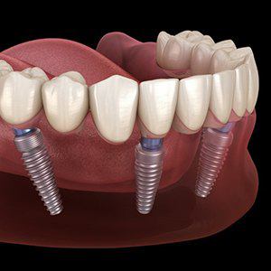 Animated smile dental implant supported denture
