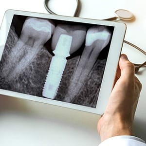 X ray of smile after bone grafting in Lincoln