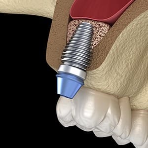 Diagram of sinus lift in Lincoln