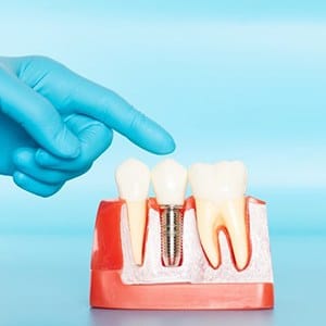Dentist pointing to model of dental implants in Lincoln