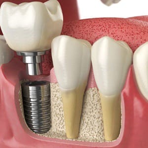 Diagram of dental implant surgery in Lincoln