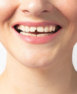 We can repair your broken teeth near Yankee Hill