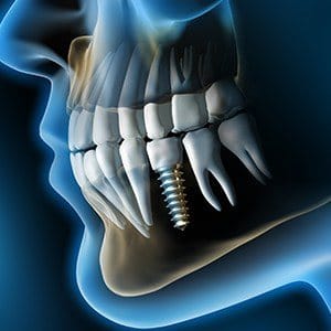 Animation of dental implant supported dental crown