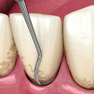A CGI of scaling and root planing