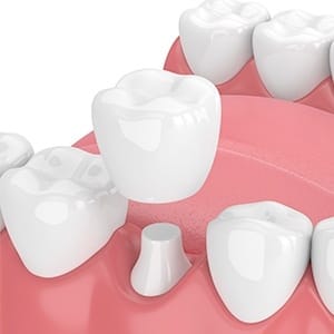 Animation of dental crown placement
