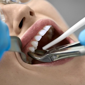 Person undergoing a tooth extraction