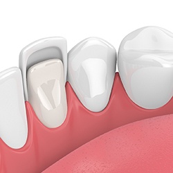 Animated smile receiving veneers