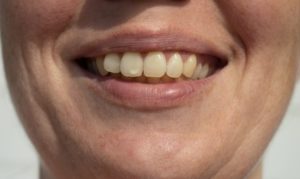 A closeup of white spots on teeth
