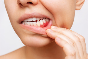 Closeup of someone’s inflamed gums