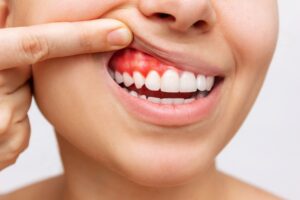 Nose-to-neck view of woman pulling back upper lip to reveal dark red gums